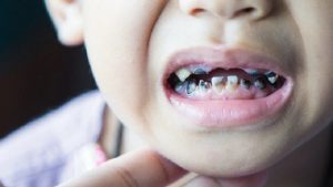 چرا دندان کودکان سیاه میشود؟