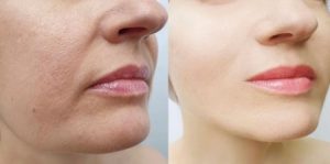 بهترین روشهای آرایشی رفع افتادگی گوشه لب