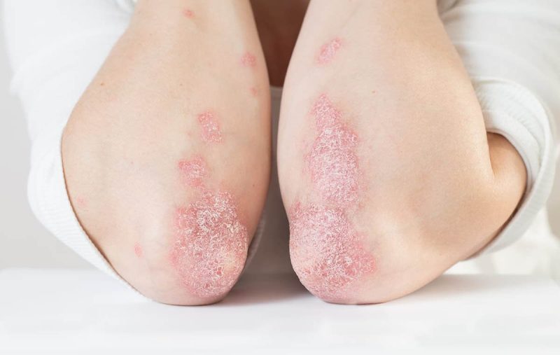 راهکارهای ساده برای کنترل اگزما